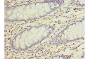 Immunohistochemistry of paraffin-embedded human colon cancer using ABIN7168469 at dilution of 1:100 (RUSC1 anticorps  (AA 231-433))