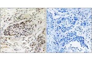 Immunohistochemistry analysis of paraffin-embedded human lung carcinoma tissue, using APBA2 Antibody. (APBA2 anticorps  (AA 371-420))
