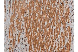 ABIN6268699 at 1/200 staining human liver cancer tissue sections by IHC-P.