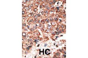 Formalin-fixed and paraffin-embedded human hepatocellular carcinoma tissue reacted with MMP20 polyclonal antibody  , which was peroxidase-conjugated to the secondary antibody, followed by DAB staining. (MMP20 anticorps  (Internal Region))