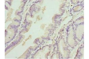 Immunohistochemistry of paraffin-embedded human prostate cancer using ABIN7149547 at dilution of 1:100
