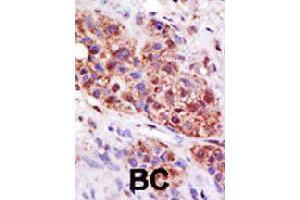 Formalin-fixed and paraffin-embedded human cancer tissue reacted with UBE2B polyclonal antibody  , which was peroxidase-conjugated to the secondary antibody, followed by DAB staining. (UBE2B anticorps  (C-Term))