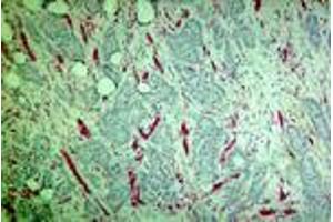 Carcinoma of the breast (MAb CE6, PECAM-1) (CD31 anticorps)
