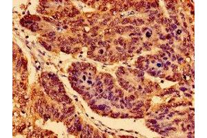 Immunohistochemistry of paraffin-embedded human gastric cancer using ABIN7155192 at dilution of 1:100