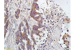Formalin-fixed and paraffin embedded human colon carcinoma labeled with Rabbit Anti-TIMP-1(NT) Polyclonal Antibody, Unconjugated (ABIN668331) at 1:200 followed by conjugation to the secondary antibody and DAB staining.