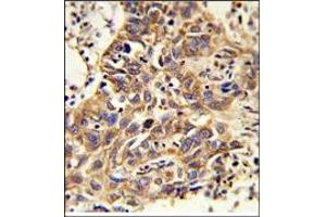 Immunohistochemistry: AP17923PU-N CAT Antibody staining of Formalin-Fixed, Paraffin-Embedded Human Lung carcinoma. (Catalase anticorps  (AA 159-188))