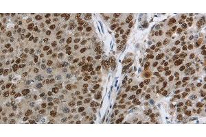 Immunohistochemistry of paraffin-embedded Human liver cancer using MCM3 Polyclonal Antibody at dilution of 1:30