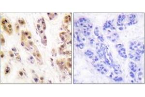 Immunohistochemistry analysis of paraffin-embedded human breast carcinoma, using SSB (Phospho-Ser366) Antibody. (SSB anticorps  (pSer366))