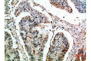 Immunohistochemical analysis of paraffin-embedded human-colon-cancer, antibody was diluted at 1:200