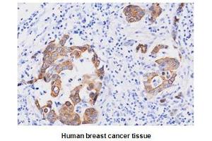Paraffin embedded sections of human breast cancer tissue were incubated with anti-human FADD (1:50) for 2 hours at room temperature. (FADD anticorps)