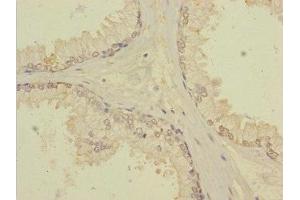 Immunohistochemistry of paraffin-embedded human prostate cancer using ABIN7171903 at dilution of 1:100 (TTC12 anticorps  (AA 1-260))
