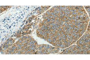 Immunohistochemistry of paraffin-embedded Human liver cancer tissue using SLC16A1 Polyclonal Antibody at dilution 1:50 (SLC16A1 anticorps)