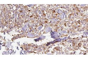 ABIN6277005 at 1/100 staining Human Melanoma tissue by IHC-P. (APCS anticorps  (Internal Region))