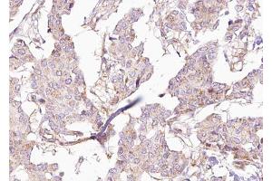 ABIN6273033 at 1/100 staining Human breast cancer tissue by IHC-P. (BCS1L anticorps  (Internal Region))