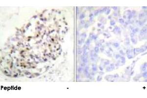 Immunohistochemical analysis of paraffin-embedded human breast carcinoma tissue using KIF20A polyclonal antibody . (KIF20A anticorps)