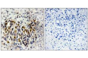 Immunohistochemistry analysis of paraffin-embedded human breast carcinoma tissue, using IRX3 antibody. (IRX3 anticorps  (Internal Region))