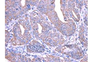 The image on the left is immunohistochemistry of paraffin-embedded Human esophagus cancer tissue using ABIN7128033(THAP6 Antibody) at dilution 1/25, on the right is treated with fusion protein. (THAP6 anticorps)