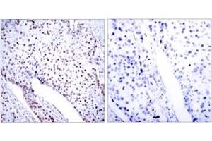 Immunohistochemistry analysis of paraffin-embedded human breast carcinoma tissue, using STAT3 (Ab-705) Antibody. (STAT3 anticorps  (AA 672-721))