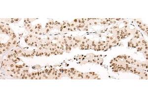 Immunohistochemistry of paraffin-embedded Human liver cancer tissue using VPS51 Polyclonal Antibody at dilution of 1:65(x200) (VPS51 anticorps)