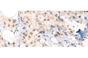 Immunohistochemistry of paraffin-embedded Human breast cancer tissue using VPS51 Polyclonal Antibody at dilution of 1:65(x200) (VPS51 anticorps)