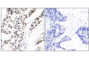 Immunohistochemical analysis of paraffin- embedded human breast carcinoma tissue using Estrogen Receptor-α (phospho-Ser106) antibody (E011071). (Estrogen Receptor alpha anticorps  (pSer106))