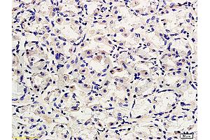 Formalin-fixed and paraffin embedded human gastric adenocarcinoma labeled with Rabbit Anti-CD45/B220 Polyclonal Antibody, Unconjugated (ABIN669606) at 1:200 followed by conjugation to the secondary antibody and DAB staining. (CD45 anticorps  (AA 1210-1304))