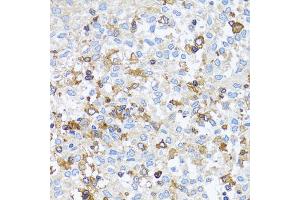 Immunohistochemistry of paraffin-embedded human lung cancer using ACTR2 antibody. (ACTR2 anticorps)