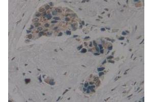 IHC-P analysis of Human Breast Cancer Tissue, with DAB staining. (Cytokeratin 1 anticorps  (AA 487-644))