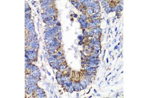 Immunohistochemistry of paraffin-embedded human colon carcinoma using RALB antibody at dilution of 1:100 (x40 lens). (RALB anticorps)