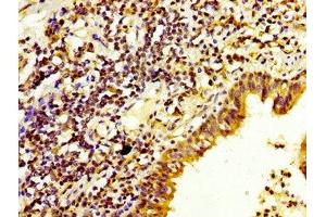 IHC image of ABIN7150781 diluted at 1:200 and staining in paraffin-embedded human lung cancer performed on a Leica BondTM system. (DUSP6 anticorps  (AA 100-206))