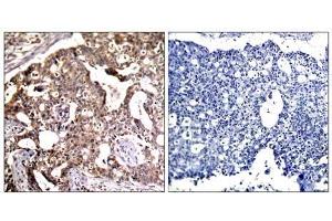 Immunohistochemical analysis of paraffin- embedded human breast carcinoma tissue, using SEK1/MKK4 (Ab-80) antibody (E021132). (MAP2K4 anticorps)