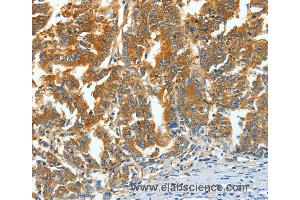 Immunohistochemistry of Human gastric cancer using ASNS Polyclonal Antibody at dilution of 1:60 (Asparagine Synthetase anticorps)