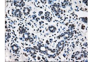 Immunohistochemical staining of paraffin-embedded breast tissue using anti-TTLL12 mouse monoclonal antibody. (TTLL12 anticorps)