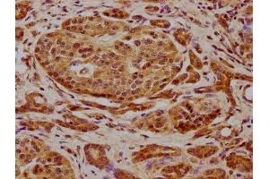IHC image of ABIN7165606 diluted at 1:600 and staining in paraffin-embedded human pancreatic cancer performed on a Leica BondTM system.