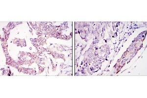 Immunohistochemical analysis of paraffin-embedded ovary tumour tissues (left) and lung cancer (right) using WIF1 mouse mAb with DAB staining. (WIF1 anticorps)