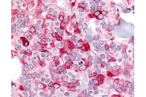 Anti-BAI2 antibody IHC of human Breast, Carcinoma.