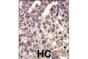 Formalin-fixed and paraffin-embedded human hepatocarcinoma tissue reacted with MTMR4 antibody (C-term), which was peroxidase-conjugated to the secondary antibody, followed by DAB staining. (MTMR4 anticorps  (C-Term))