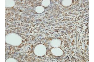Immunoperoxidase of monoclonal antibody to JAM2 on formalin-fixed paraffin-embedded human malignant lymphoma, diffuse large B tissue.