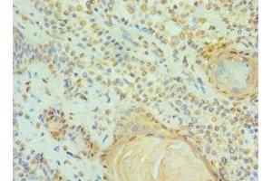 Immunohistochemistry of paraffin-embedded human breast cancer using ABIN7147295 at dilution of 1:100 (CCAR1 anticorps  (AA 1-200))