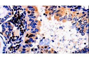 Immunohistochemistry of paraffin-embedded Human thyroid cancer tissue using ALOX5 Polyclonal Antibody at dilution 1:50 (ALOX5 anticorps)