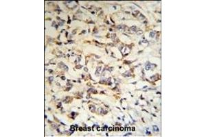 CPN2 Antibody (N-term) (R) IHC analysis in formalin fixed and paraffin embedded human breast carcinoma tissue followed by peroxidase conjugation of the secondary antibody and DAB staining.