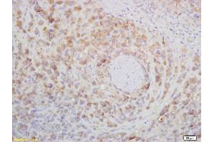 Formalin-fixed and paraffin embedded mouse lymphoma labeled with Rabbit Anti CD272/BTLA Polyclonal Antibody, Unconjugated (ABIN671031) at 1:200 followed by conjugation to the secondary antibody and DAB staining (BTLA anticorps  (AA 221-289))