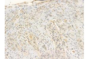 ABIN6256197 and ABIN6267469 at 1/100 staining human tongue carcinoma by IHC-P. (CDC25C anticorps  (pSer216))