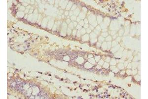 Immunohistochemistry of paraffin-embedded human colon cancer using ABIN7156542 at dilution of 1:100 (ICAM4 anticorps  (AA 20-140))