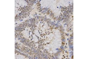 Immunohistochemistry of paraffin-embedded human rectal cancer tissue using H3K79me3 antibody at dilution of 1:200 (x400 lens). (Histone 3 anticorps  (H3K79me3))