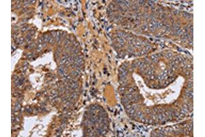 The image on the left is immunohistochemistry of paraffin-embedded Human colon cancer tissue using ABIN7130361(NDUFA1 Antibody) at dilution 1/70, on the right is treated with fusion protein. (NDUFA1 anticorps)