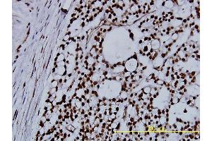 Immunoperoxidase of monoclonal antibody to NPM1 on formalin-fixed paraffin-embedded human ovary, clear cell carcinoma tissue. (NPM1 anticorps  (AA 1-294))