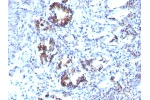Formalin-fixed, paraffin-embedded human Colon Carcinoma stained with Transgelin Monoclonal Antibody (SPM606) (Transgelin anticorps)