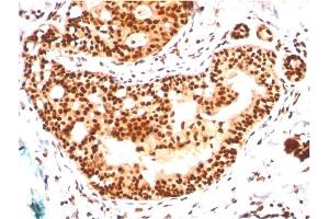 Formalin-fixed, paraffin-embedded human Breast Carcinoma stained with SUMO-2/3 Mouse Monoclonal Antibody (SM23/496) (SUMO2 anticorps)