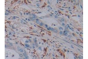 Detection of FTL in Human Colorectal cancer Tissue using Polyclonal Antibody to Ferritin, Light Polypeptide (FTL)